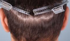 Before Hair Transplant&nbsp;Trichophytic Donor Scars